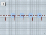 EKG - AV blok I. stupně