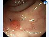 Gastrointestinální trakt - koloskopie