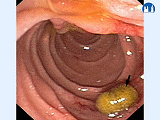 Gastrointestinální trakt -Endoskopická retrográdní cholangiopankreatografie