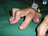 Revmatoidní artritida – kloubní deformita