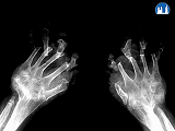 Revmatoidní artritida – RTG snímek