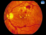Oční pozadí při diabetické makulopatii