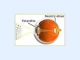 Oko s kataraktou