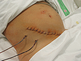 Břišní drény po operaci