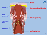 Laryngitis acuta subglottica