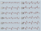 EKG křivka, AIM