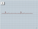 EKG - AV blok III. stupně