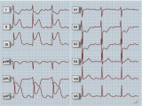 EKG - Zadní infarkt myokardu