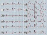 EKG - Akutní přední infarkt myokardu