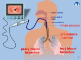 Dýchací cesty - bronchoskopie