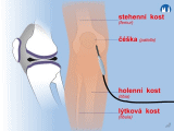 Kloubní dutiny - artroskopie