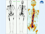Scintigrafie skeletu - karcinom prostaty