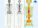 Fraktury obratlových těl při osteoporóze