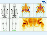 Scintigrafie skeletu - obraz Perthesovy choroby