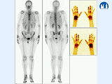 Scintigrafie skeletu - obraz artritidy