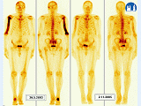 Scintigrafie skeletu - Pagetova choroba