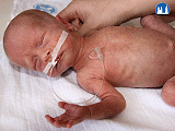 Žaludeční sonda ke krmení nedonošeného dítěte