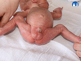 Hypospadie u nezralého novorozence