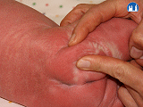 Dobře vyvinutý tukový polštář novorozence