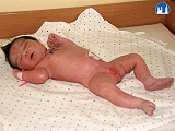 Flekční držení končetin novorozence