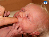 Stimulace sacího reflexu novorozence