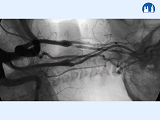Angiografie aortálního oblouku