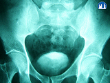 Intravenózní vylučovací urografie - cystogram