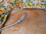 Perkutánní endoskopická gastrostomie