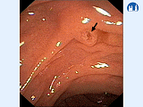 Gastrointestinální trakt - Endoskopická retrográdní cholangiopankreatografie
