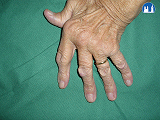 Revmatoidní artritida – kloubní deformity