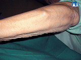 Revmatoidní artritida – revmatoidní uzel