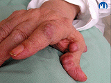 Revmatoidní artritida – revmatoidní uzel