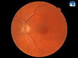 Oční pozadí - fyziologický nález na levém oku