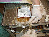 Napíchnutí setu na transfuzní vak