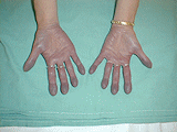 Paličkovité prsty