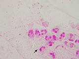 Neisseria gonorreae – mikroskopický nález