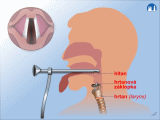 Dýchací cesty – zvětšovací laryngoskopie