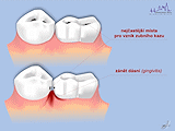 Lokalizace vzniku zubního kazu
