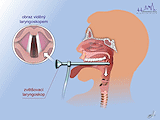 Zvětšovací laryngoskopie