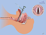 Přímá laryngoskopie 