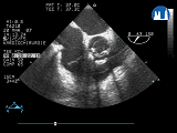 TEE - bioprotéza aortální chlopně