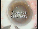 Operace katarakty